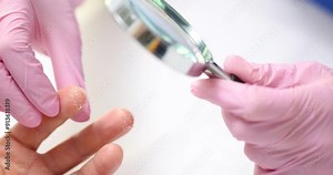 Doctor examines condition of skin on the fingers using magnifying glass