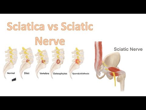 Sciatica vs Sciatic nerve