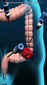 How Colectomy Surgery is Done? (3D Animation) #how #colon #vessel #digestivehealth #3danimation