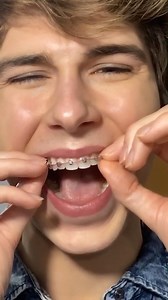 76K views · 577 reactions | He RIPPED His Braces Off?!  - - Make sure to check out our oral care company that gives back! @thesomethingniceco ❤️瘟醴 Get your Waterflossers while you can!  The world famous floss picks are also still in stock!  - - - #reels #teeth #dentistry #braces #health #reaction | TheBentistofficial | Facebook
