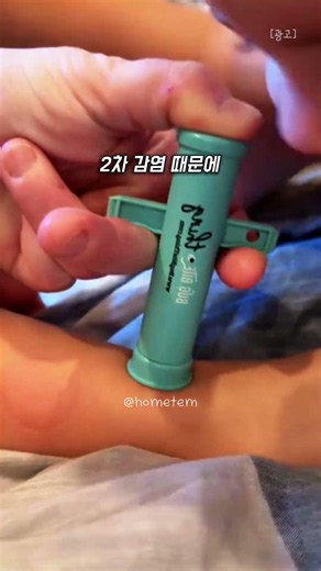 [Summer Must-Have] How to Stop Mosquito Bite Itch in 3 Seconds