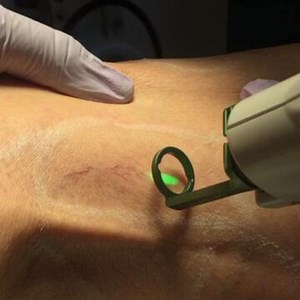 Vbeam Laser Treatment for Leg Veins