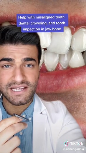 DO YOU HAVE AN EXPANDER 🦷!? #LearnOnTikTok #TikTokPartner #WinterFit | palate expander