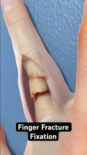 Fixing a fractured finger (3D Animation)
