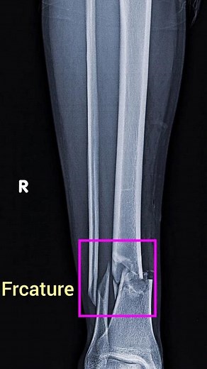 Fracture Lower Limb#radiologylecture
