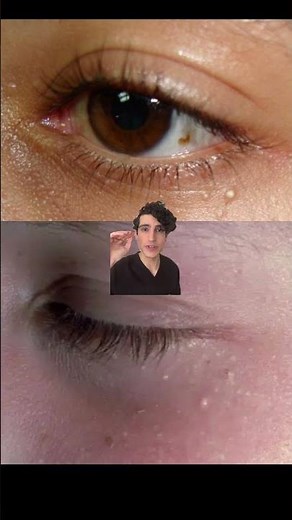 Dermatologist: what are white bumps around the eyes and how you can treat them #skincarehacks