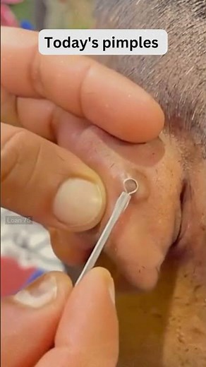 Large Blackheads Extraction Big Cystic Acne Blackheads&Whiteheads Removal Pimple Popping #1092 2026