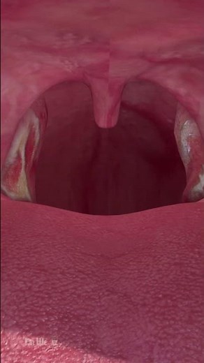 Why You Should Never Have Your Tonsils Removed