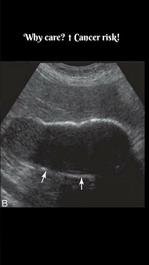 Porcelain Gallbladder on Ultrasound – Bright, Shadowed, and Risky! #gallbladder #gallbladdercancer