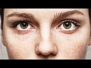 The Truth About Freckles