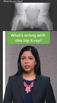 What Is SCFE? Slipped Capital Femoral Epiphysis Explained 🦴