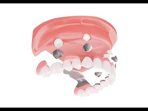 Behandlungsablauf: Teleskopprothese Zahnersatzsparen.de