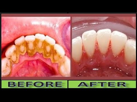How To Clean Yellow Teeth Naturally and Remove Dental Plaque Without Tooth Paste In 2 Minutes