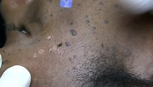 DPN Removal With Ellman Radiowave Surgery