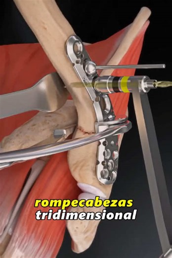 Understanding Broken Collarbone Treatments with 3D Animation