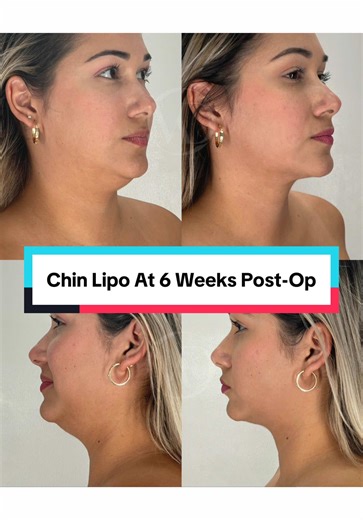 Chin liposuction by Dr. Z at 6 weeks post-op 😍 #chinlipo #chinliposuction #lipo #liposuction #plasticsurgerytok