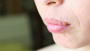 Herpes labialis, also called cold sores among other names, is a type of herpes simplex occurring on the lip, ie an infection caused by herpes simplex virus (HSV)