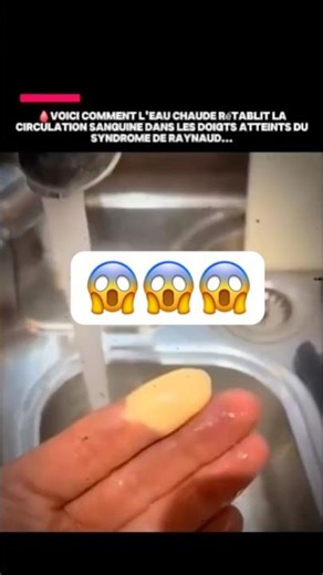 🩸 Comment l’eau chaude soulage le syndrome de Raynaud #shorts #santé #raynaud