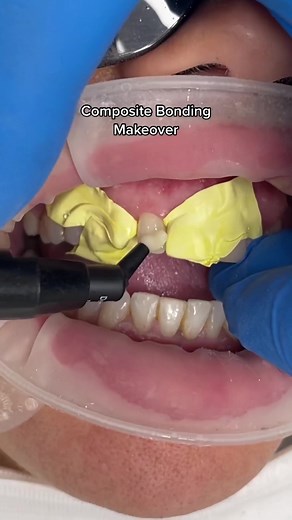 Dr Richard using composite bonding on 4 upper teeth to correct the small overlap of the front teeth and create more even edges 🤍