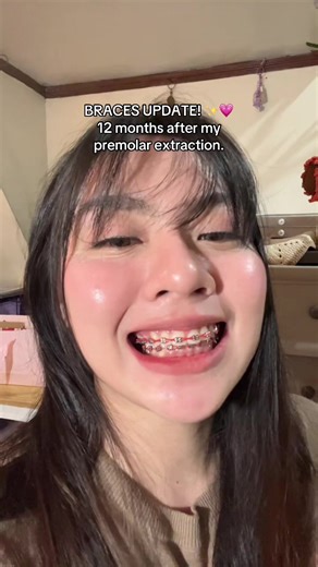 Braces Update: 12 Months After Premolar Extraction