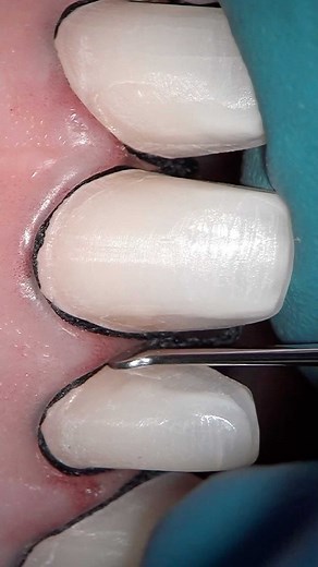 BELOGRAD Dental Academy on Instagram: "Retraction tips and problems. Few hottest questions to discuss: 1. How to avoid recession after preps and retraction? 2. Single or double cord for impression? ⠀ 1. Let’s take away occlusion and other chronic traumas and discuss problems that may cause recession during preps and retraction: 🔹 biological width vioalance. - How to solve: Don’t prep deeper than half way of free sulcus. ⠀ 🔹forced retraction. - How to solve: Place retraction cord gently respect