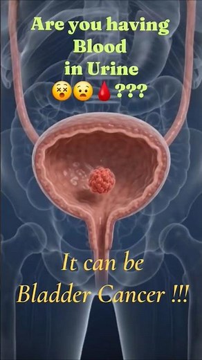 Bladder Cancer: Early Warning Signs & Risk Factors You Shouldn't Ignore
