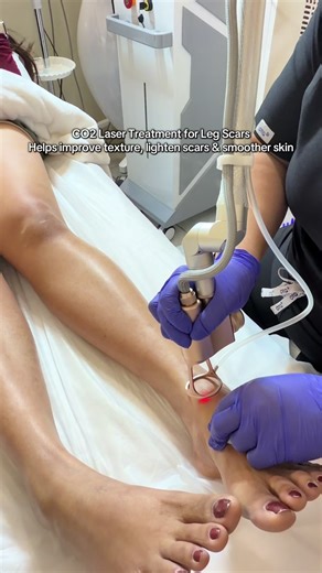 May scars sa legs? Don’t worry, we got you! ✨ CO2 Laser Treatment for Leg Scars Helps improve texture, lighten scars & smoother skin 💫 No filter, real skin confidence! Book your appointment now at CPS Aesthetics 💖 #CO2Laser #ScarRemoval #LegScarTreatment #SmoothSkin #scar