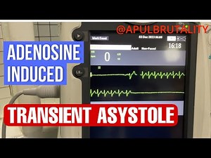 Adenosine-induced transient asystole during SVT treatment