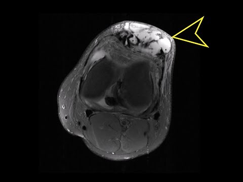 Knee MRI Patellar Tendon Partial Tear with Cysts