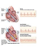 Patient Teaching Aid: Arrhythmia