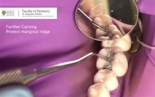 operative dentistry-银汞充填