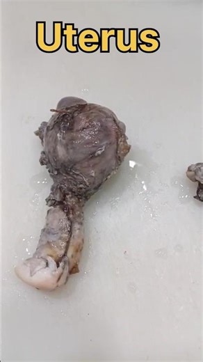 Uterus specimen cutting 🧐✂️🛑| #histopathology #histomuseum #uterineprolapse #uterusremoval #uterus