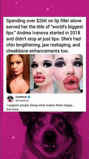 Spending over $26K on lip filler alone earned her the title of "world's biggest lips" Andrea Ivanova