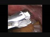 Laparoscopic Tubal Ligation with Filshie Clips • Video • MEDtube.net