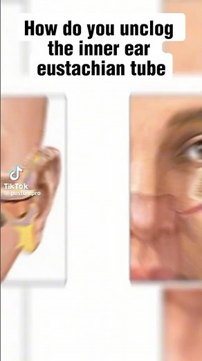 Eustachian tube dysfunction- exercises / valsalva maneuver