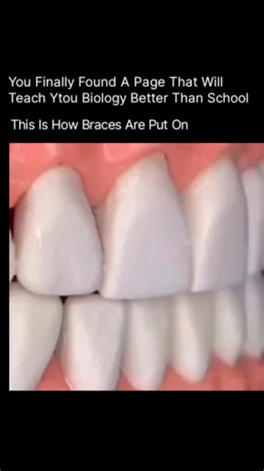 Anatomy | Physiology | Body facts on Instagram: "This is how braces are put on 🦷✨ Getting braces isn’t painful magic—it’s precise dental science. First, the orthodontist thoroughly cleans and dries your teeth so everything bonds perfectly. Then a special dental adhesive is applied, and small brackets are carefully placed on each tooth in exact positions. A blue curing light hardens the glue in seconds, locking the brackets in place. Next, a thin archwire is threaded through the brackets. This w