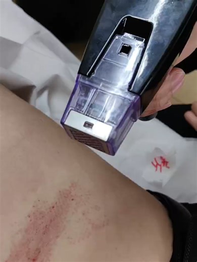 M8 RF Fractional Scar Removal Skin Tightening Wrinkle Removal Fractional RF Microneedling Device #m8 #rf #micro #needle #mirconeedling #skintightening#wrinkle #scar #anti #skincaretiktok #wrinklereduction #facecare