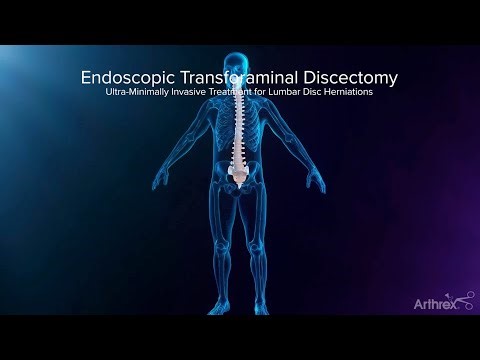 Endoscopic Transforaminal Approach for a Herniated Disc