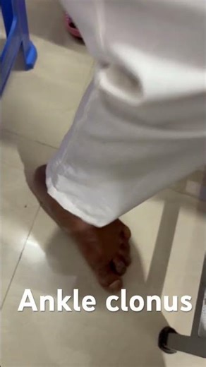 Ankle clonus. To and fro movement of ankle in a patient of post stroke spasticity.
