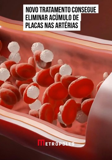 Pesquisadores da #Universidade Estadual de #Michigan e da Universidade #Stanford estão desenvolvendo um método para combater a #aterosclerose, doença caracteriza pelo entupimento das artérias devido a formação de placas de gordura. Usando nanopartículas mais finas que um fio de #cabelo humano, carregadas com um medicamento capaz de ativar células imunológicas, os pesquisadores conseguiram tratar a aterosclerose em porcos. “Usando exames de PET [tomografia por emissão de pósitrons], conseguimos m