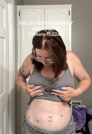 Recovering from Gallbladder Surgery: Pain and Progress