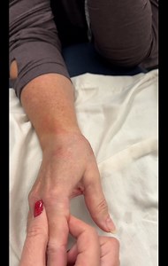 Post op CMC JOINT replacement and PAIN!!! Can we please give credit to the dorsal scar for the PAIN And then layer years of skin tensions towards the ulna wrist that created CMC joint pain in the first place! This is one of the BEST VIDEOS about CMC pain/ skin adherence to the EPL tendon/involvement of sensory nerves and TREMORS and the importance of skin directions and movement dysfunction?!?!?! All wrapped in 3 MINS!! #walkadifferentdirection #CMC#tremors Alisontayloracademy.com | Kinesioaliso