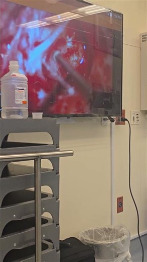 Drilling out mastoid (left side) for cochlear implant insertion