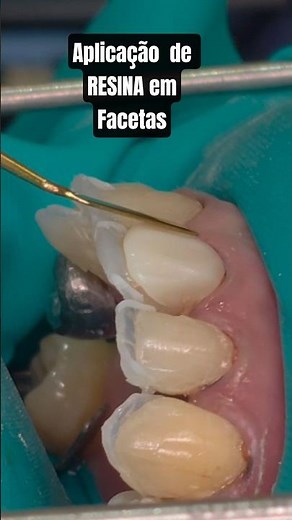 🎯APLICAÇÃO de RESINA em Facetas #facetasderesina #dentista #Facetas