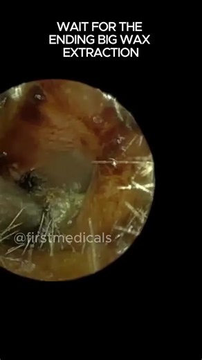 Massive Earwax Extraction for Satisfying Results