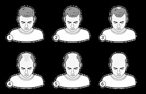 Scalp Tension and Scalp Massages for Hair loss - Hairguard