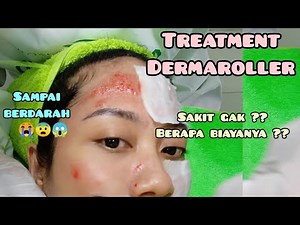 (PART 1) Dermaroller Treatment for Pockmark Scar Removal at Naavagreen Bojonegoro || Tira Intan B...