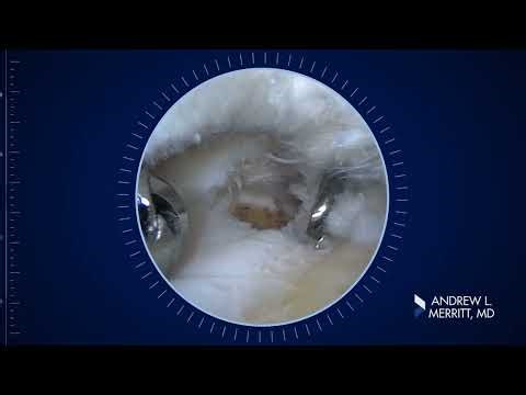 Medial Meniscus Root Repair