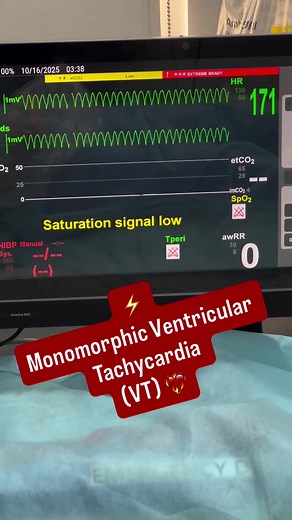 Understanding Tachycardia Types and Their Management