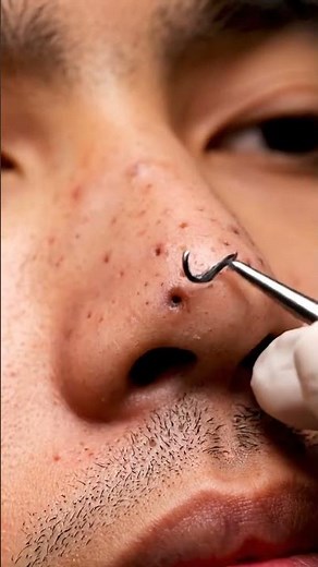 Under Nose Blackhead Extraction | Smooth Clean Pore Detail